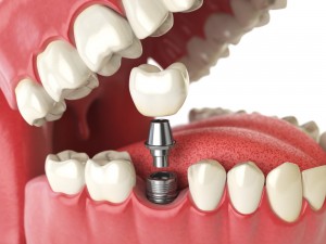 Стоит ли выбирать имплантацию зуба?
