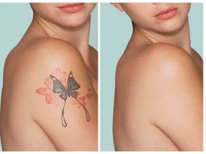 Является ли удаление татуировки эффективным?
