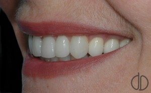 Восстановление зубов зубными коронками