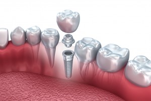 Одномоментная имплантация зубов: особенности и преимущества