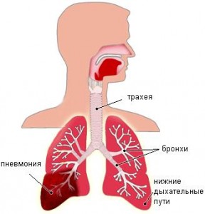 Пневмония - воспаление легких