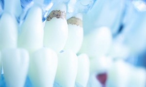 Лечение кариеса в современных стоматологических клиниках